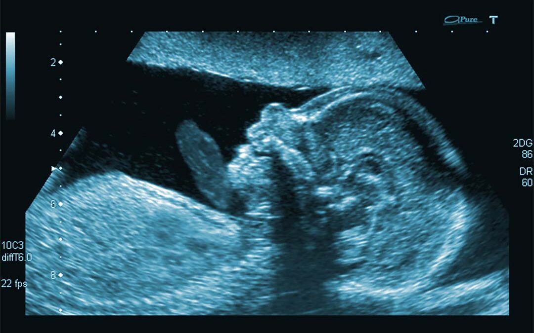 Ultrasound Imaging