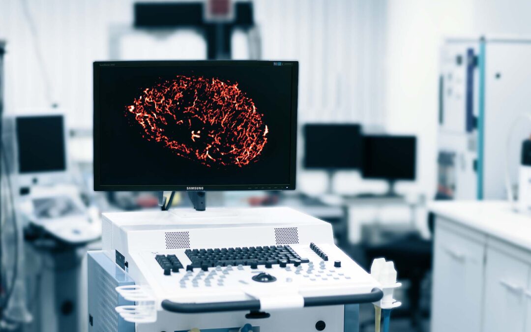 Weiterentwicklung der bewegungsmodellbasierten Ultraschall-Lokalisationsmikroskopie zur Unterstützung der Brustkrebsdiagnostik und Therapieüberwachung in Patienten